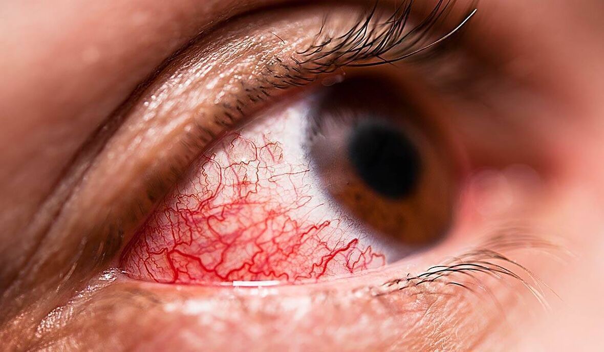 Diabetická retinopatie je jednou z pozdních komplikací cukrovky